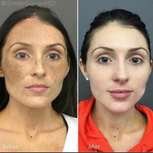 patient before and after melasma Coolaser skin treatment