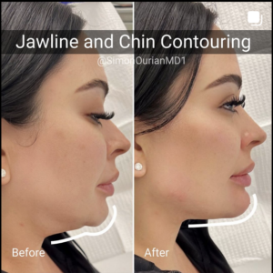 image of before and after for chin augmentation and jawline contouring patient