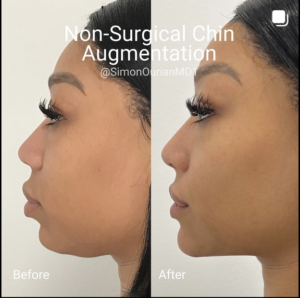 before and after non-surgical chin contouring patient