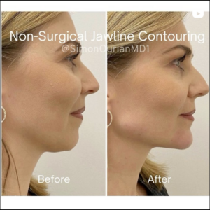 before and after photos for chin contouring patient