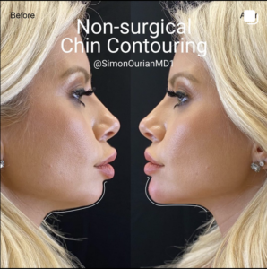 patient at Epione before and after non-surgical chin augmentation