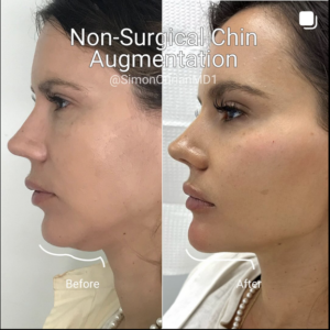 before and after photo for chin augmentation