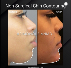 patient before and after chin contouring without surgery