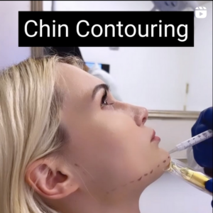 patient about to have non-surgical chin contouring