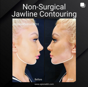 before and after patient for jawline contouring