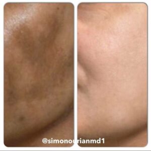 patient before and after melasma treatment