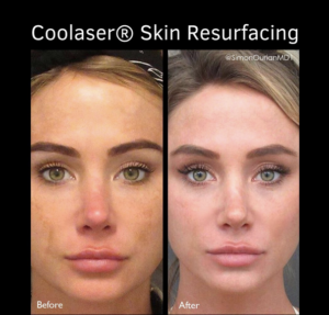 before and after coolaser treatment patient with brighter skin