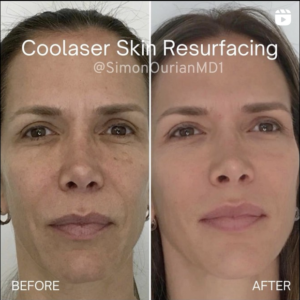 Coolaser treatment before and after Epione patient