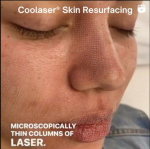 image of patient about to have Coolaser treatment
