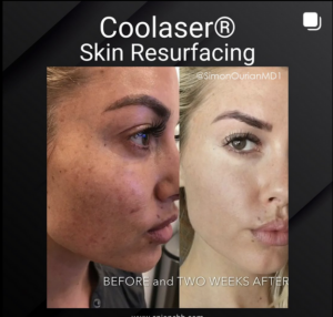 before and after coolaser treatment