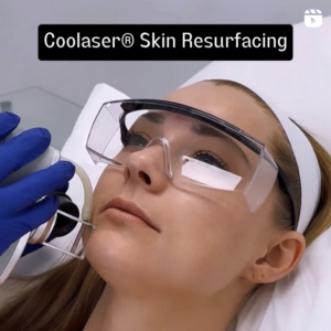 real patient having Coolaser skin resurfacing at Epione clinic