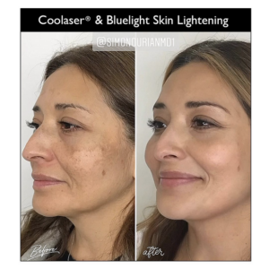 before and after coolaser treatment of real patient