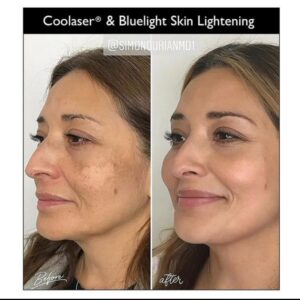 patient before and after Coolaser treatment for melasma
