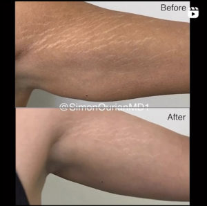 before and after stretch marks removal patient results