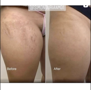 patient before and after her stretch mark reduction for upper thighs