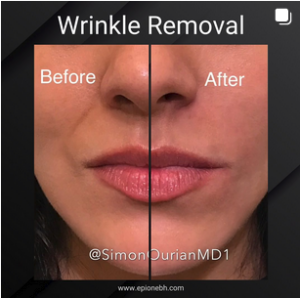 wrinkle removal patient