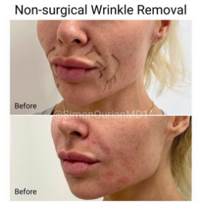 before and after wrinkle removal treatment
