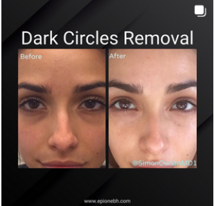 under-eye wrinkle removal