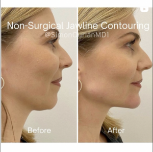 How to get rid of double chin and define jawline outlet